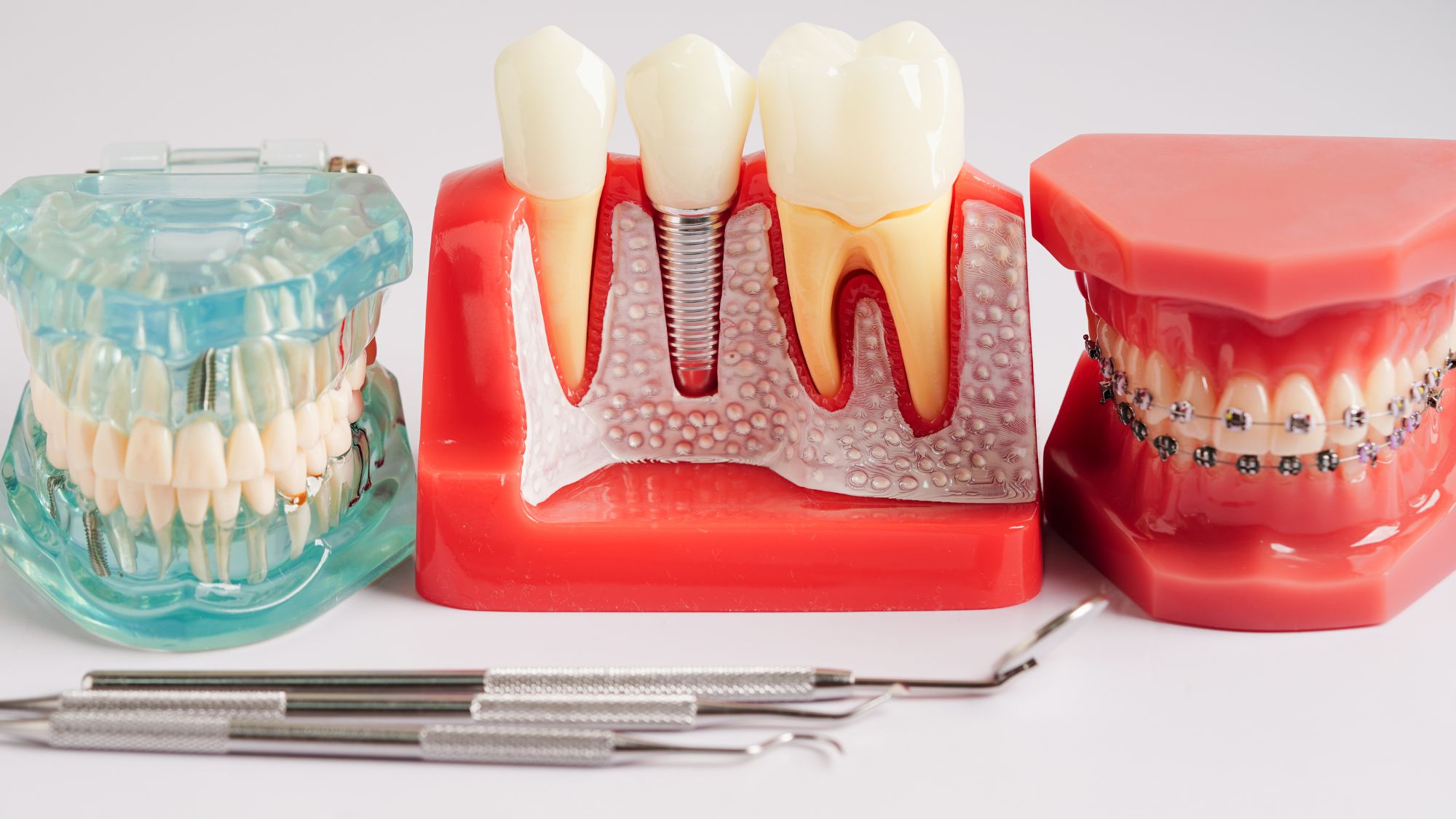 A dentist showcasing different dental models to explain how toothbrushing fights cavities and gum disease