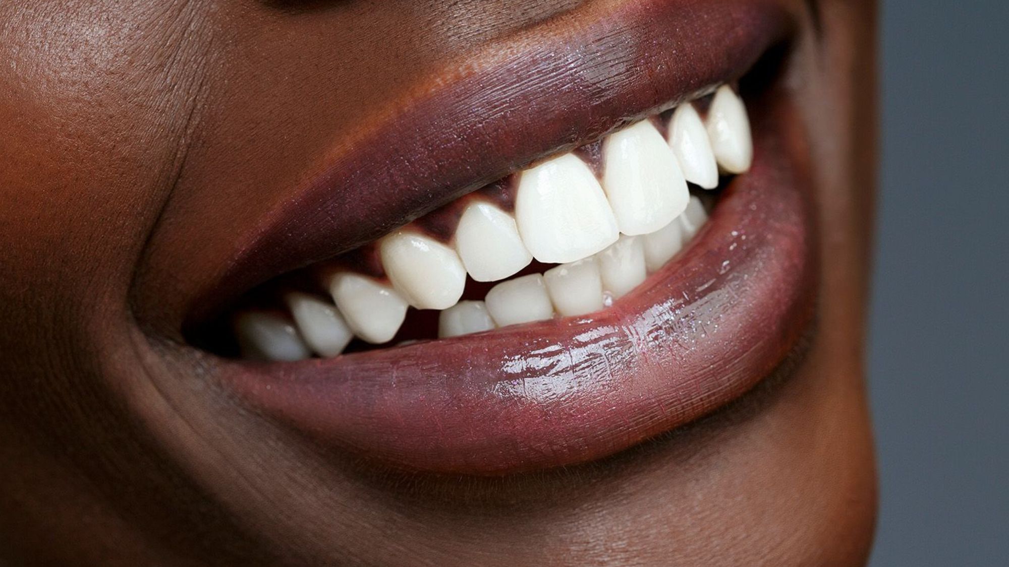 A black woman smiling and showing her teeth after teeth whitening treatment