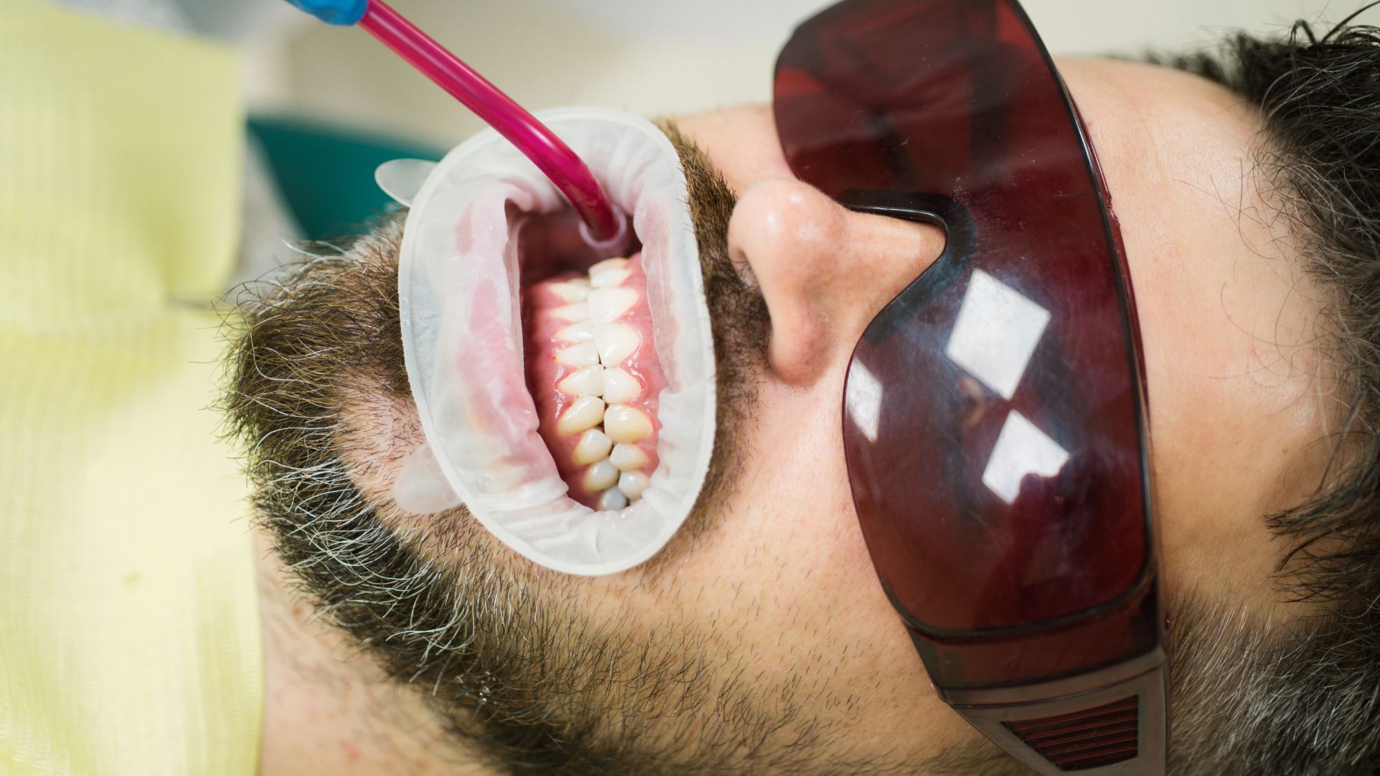 A coffee and tea drinker patient is undergoing a professional teeth whitening process in a dental clinic