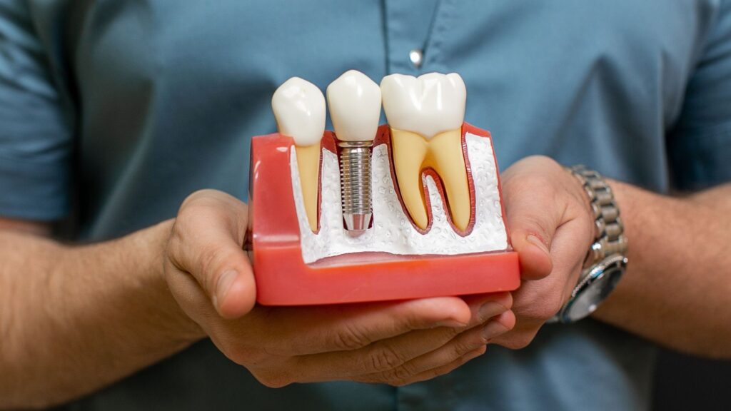 A dentist holding a model of dental implants