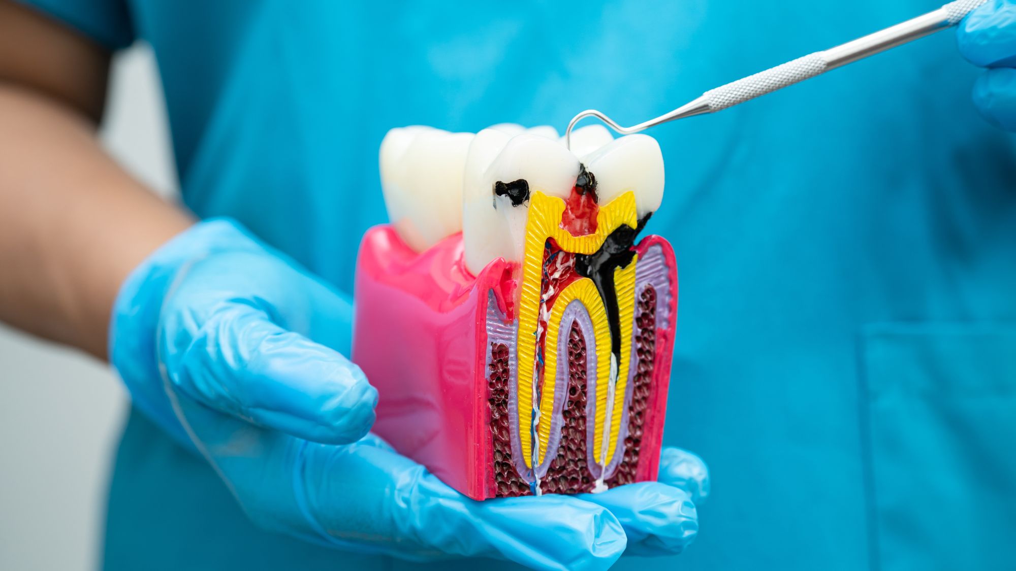 A doctor holding a tooth model while explaining why teeth hurt and how root canal therapy helps