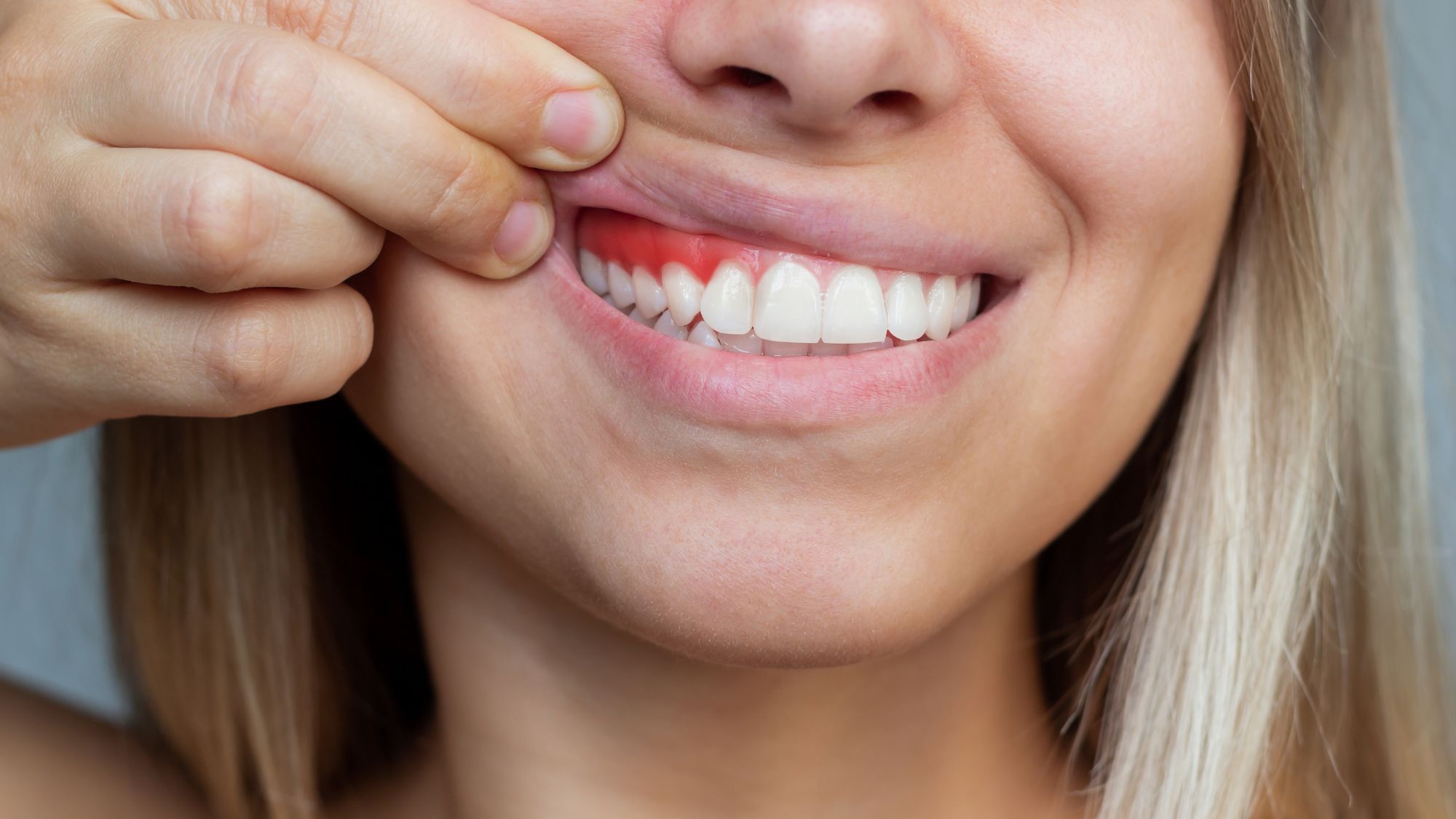 A girl showcasing gum recession problems