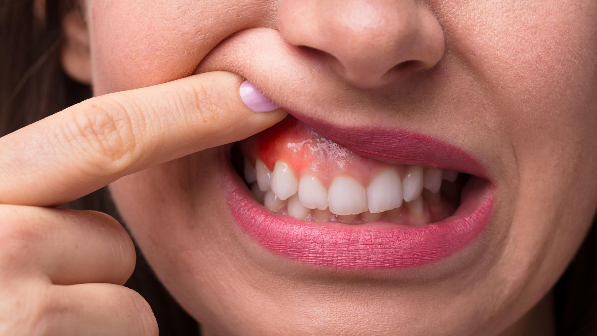 A woman holding her lips and showing her gums affected due to gum disease