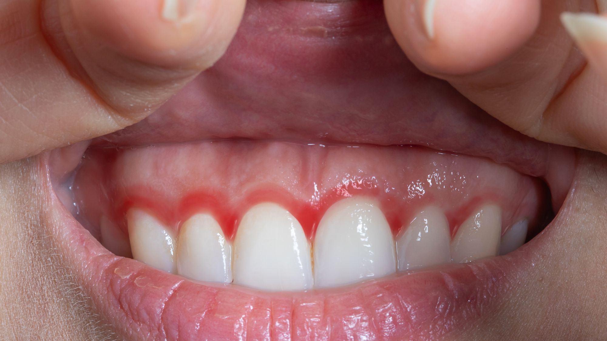 A woman showing her bleeding gums during pregnancy