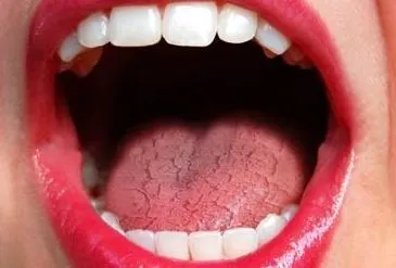What Causes Dry Mouth After Surgery?