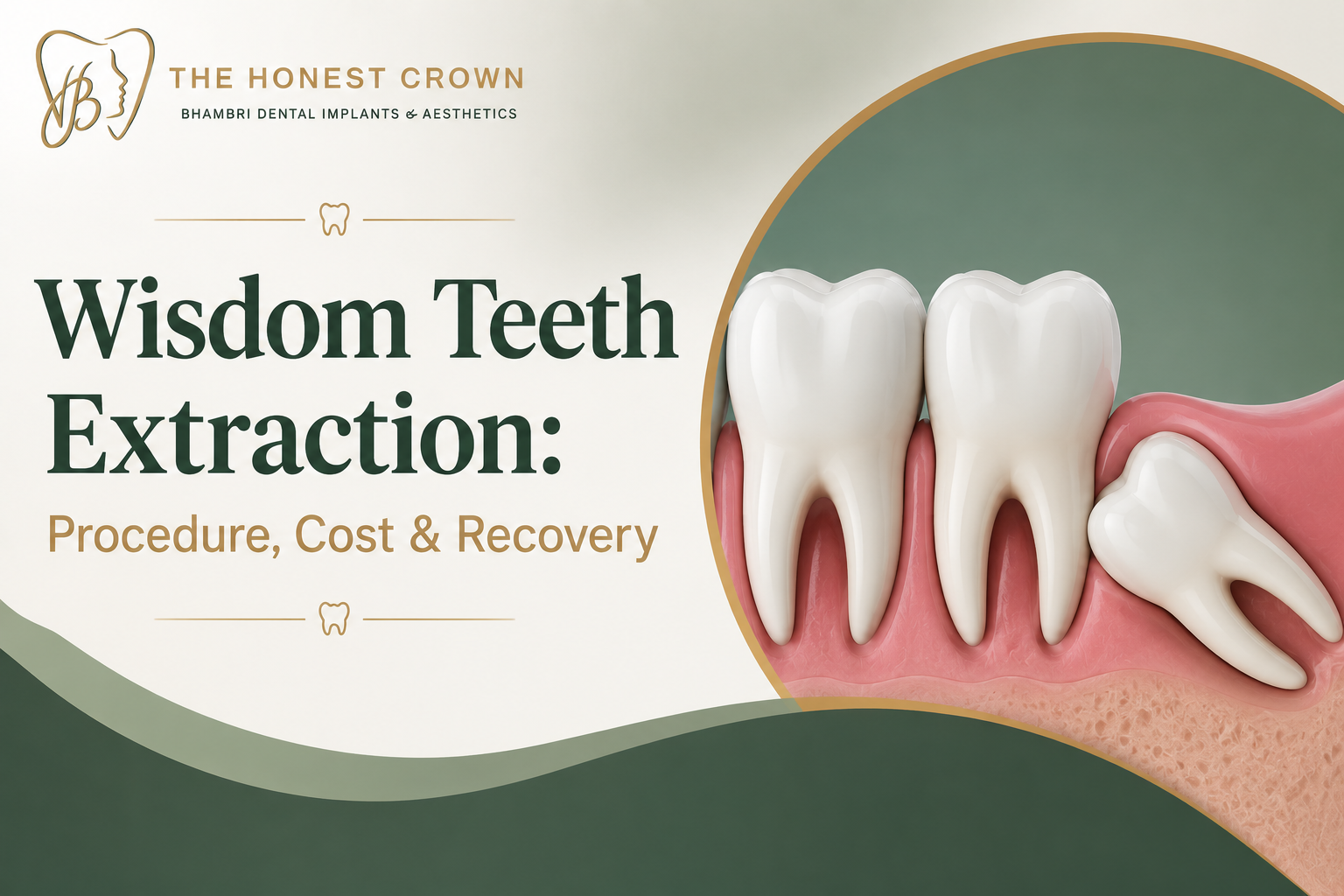 Wisdom Teeth Extraction Procedure, Cost & Recovery