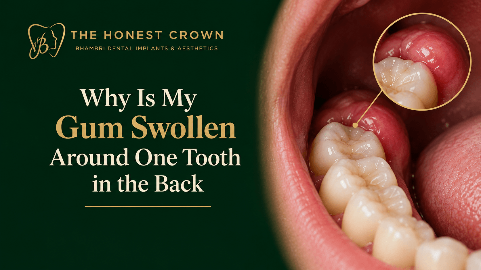 Swollen gum around a back molar, highlighted in a dental close-up on a dark green and gold background.